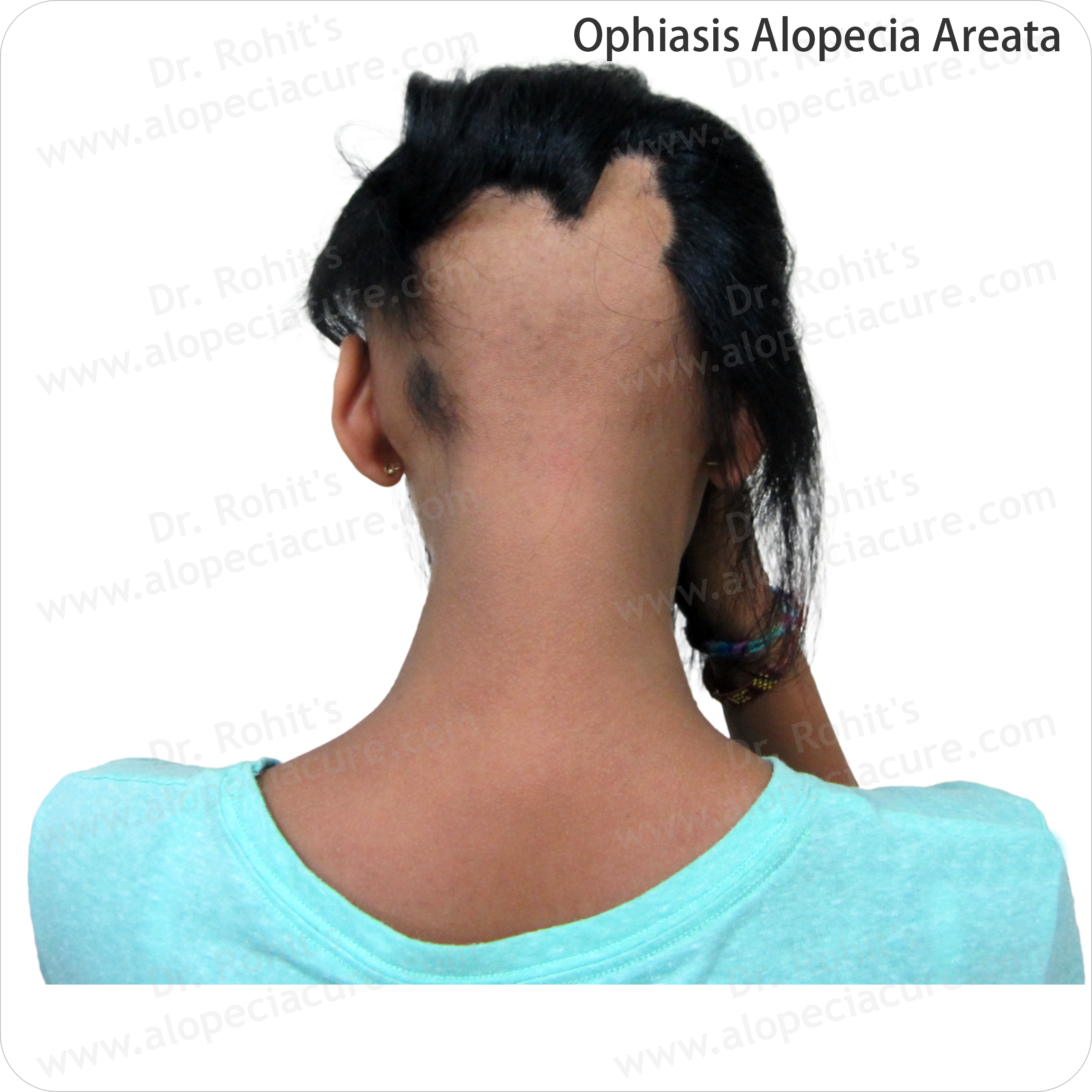Alopecia Result